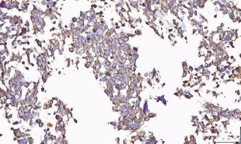 IHC staining of FFPE human lung cancer tissue with Uridylate-specific endoribonuclease antibody. HIE
