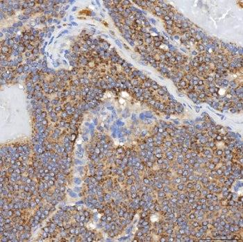 IHC staining of FFPE human breast cancer tissue with SGCE antibody. HIER: boil tissue sections in pH