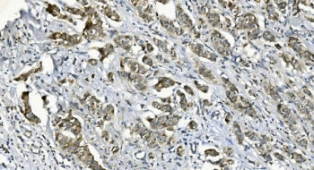 IHC staining of FFPE human breast cancer with Diacylglycerol kinase zeta antibody. HIER: boil tissue