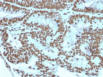 IHC staining of FFPE human breast carcinoma with ZNF846 antibody. HIER: boil tissue sections in pH 9