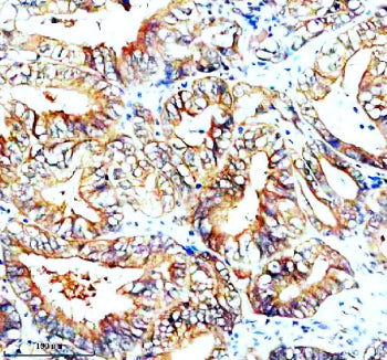 Immunohistochemical staining of SNX2 using anti-SNX2 antibody. SNX2 was detected in a paraffin-embed