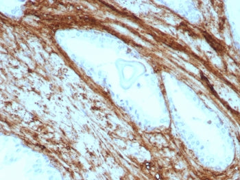 IHC staining of FFPE human prostate carcinoma tissue with recombinant Decorin antibody (clone DCN/87