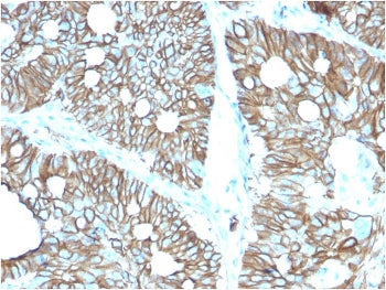 IHC staining of FFPE human colon with Cadherin 17 antibody (clone CDH17/2616). HIER: boil tissue sec