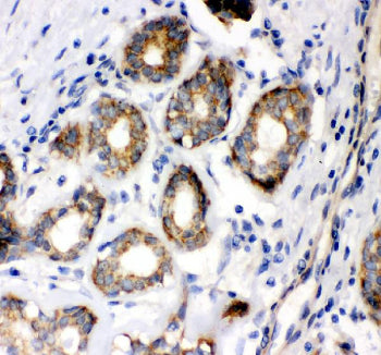 IHC staining of FFPE human breast cancer tissue with FAK antibody, HRP-secondary and DAB substrate. 