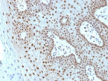 IHC: Formalin-fixed, paraffin-embedded human cervical carcinoma stained with c-Myc antibody (MYC275 