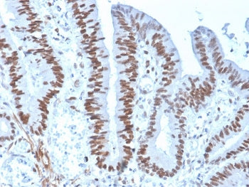 IHC staining of FFPE human colon carcinoma with recombinant MSH6 antibody (clone rMSH6/4743). HIER: 