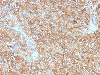 IHC staining of FFPE human prostate carcinoma with recombinant CD63 antibody (clone LAMP3/2990R). HI