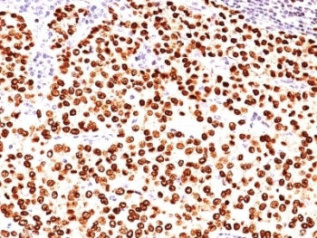 IHC: Formalin-fixed, paraffin-embedded human breast carcinoma stained with anti-Progesterone Recepto