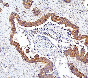 IHC staining of FFPE human colon carcinoma with mTOR antibody. HIER: boil tissue sections in pH6 cit