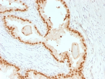 IHC testing of FFPE human prostate carcinoma with recombinant FOXA1 antibody (clone rFOXA1/1515). HI