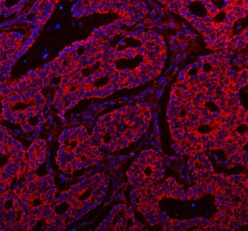 Immunofluorescent staining of FFPE human intestinal cancer tissue with SSH3BP1 antibody (red) and DA