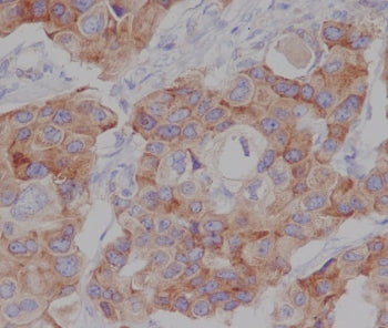 IHC staining of FFPE human breast cancer tissue with Phospho-mTOR antibody antibody. HIER: boil tiss