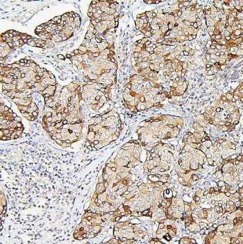 IHC staining of FFPE human breast cancer with Aldolase A antibody. HIER: boil tissue sections in pH6