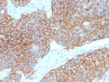 Formalin-fixed, paraffin-embedded human colon carcinoma stained with recombinant E-Cadherin antibody