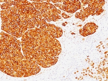 IHC: Formalin-fixed, paraffin-embedded human melanoma stained with Tyrosinase antibody (clone SPM360