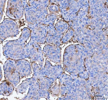 IHC staining of FFPE human liver cancer tissue with AQP1 antibody. HIER: boil tissue sections in pH8