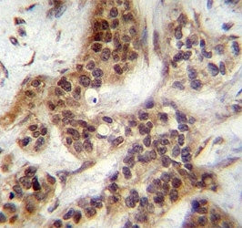 FOXA2 antibody immunohistochemistry analysis in formalin fixed and paraffin embedded human bladder c