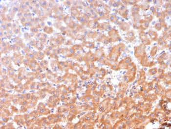 IHC staining of FFPE human hepatocellular carcinoma tissue with ADH1L1 antibody (clone ALDH1L1/7958)