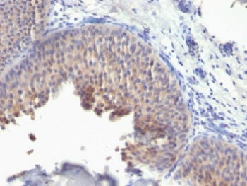 Formalin-fixed, paraffin-embedded human bladder carcinoma stained with anti-Keratin 10 antibody (KRT