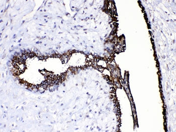 IHC testing of FFPE human breast cancer tissue with CASP8 antibody at 1ug/ml. HIER: steam section in
