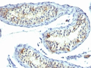 IHC: Formalin-fixed, paraffin-embedded human testicular carcinoma stained with Prolactin Receptor an