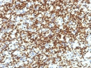 IHC testing of formalin-fixed, paraffin-embedded human Rhabdomyosarcoma with PAX7 antibody (clone PA