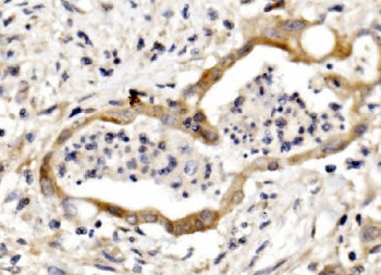 IHC staining of FFPE human rectal cancer with Nectin 3 antibody. HIER: boil tissue sections in pH8 E