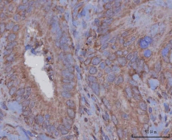 IHC staining of FFPE human rectum adenocarcinoma tissue with Serpin A8 antibody. HIER: boil tissue s