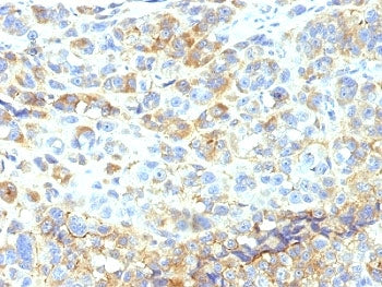IHC analysis of formalin-fixed, paraffin-embedded human melanoma stained with ICAM-1 antibody (clone