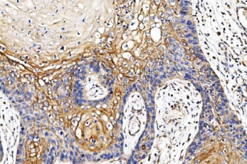 IHC staining of FFPE human esophageal squamous carcinoma tissue with Cytochrome P450 Reductase antib