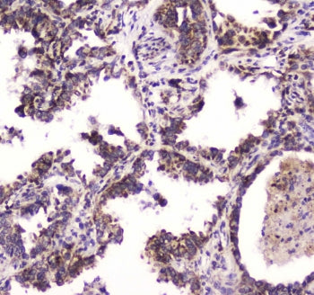 IHC testing of FFPE human lung cancer tissue with BRD7 antibody at 1ug/ml. Required HIER: steam sect