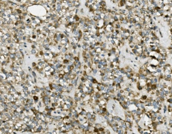 IHC staining of FFPE human pancreatic cancer with TRIM25 antibody. HIER: boil tissue sections in pH8