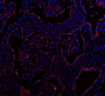 Immunofluorescent staining of FFPE human lung cancer tissue with GbetaL antibody (red) and DAPI nucl