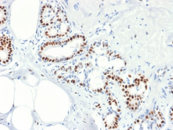 IHC testing of FFPE human breast cancer with Estrogen Receptor alpha antibody (clone rESR1/1935). Re