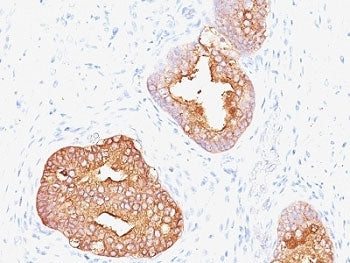 IHC: Formalin-fixed, paraffin-embedded human prostate carcinoma stained with Prostate Specific Antig