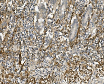 IHC staining of FFPE human rectal cancer with Sprouty 4 antibody. HIER: boil tissue sections in pH8 