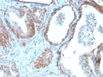 IHC staining of FFPE human prostate carcinoma with TIGIT antibody (clone TIGIT/3016). HIER: boil tis