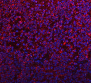 Immunofluorescent staining of FFPE human glioma tissue with PYCR1 antibody (red) and DAPI nuclear st