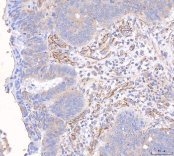 Immunohistochemical staining of FFPE human rectal cancer tissue with ANG2 antibody, HRP-secondary an