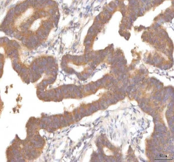 IHC staining of FFPE human colon adenocarcinoma tissue with MFSD12 antibody. HIER: boil tissue secti