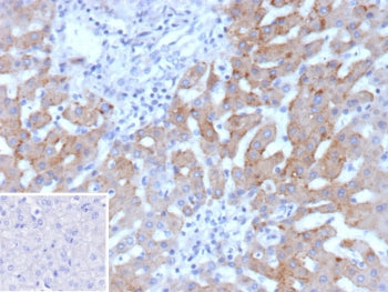 IHC staining of FFPE human hepatocellular carcinoma tissue with HSD17B13 antibody (clone HSD17B13/13