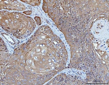 IHC staining of FFPE human laryngeal squamous cell carcinoma tissue with YWHAE antibody. HIER: boil 