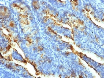 IHC testing of FFPE human uterine carcinoma with FSHR antibody (clone FSHR/1400). Required HIER: boi