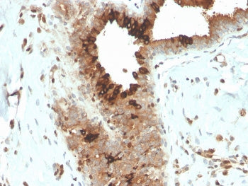 IHC staining of FFPE human breast carcinoma with recombinant Mammaglobin antibody (clone MGB/4057R).