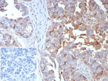 IHC staining of FFPE human ovarian cancer tissue with MX1 antibody (clone MX1/7529). Inset: PBS used