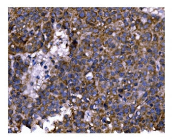 IHC staining of FFPE human liver cancer tissue with PFKFB2 antibody. HIER: boil tissue sections in p
