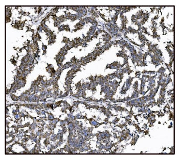 IHC staining of FFPE human ovarian cancer tissue with Glutamate-oxaloacetate transaminase 2 antibody