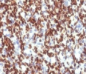 IHC testing of FFPE human Rhabdomyosarcoma with PAX7 antibody (clone PBPX7). Required HIER: boil tis