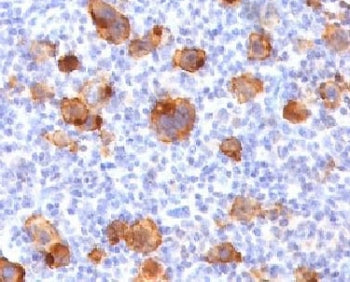 IHC testing of FFPE human Hodgkin's lymphoma with recombinant CD30 antibody (clone rKi-1/779). Requi