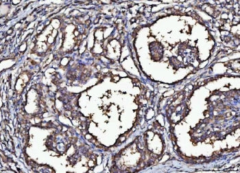 IHC staining of FFPE human thyroid cancer tissue with MARK3 antibody. HIER: boil tissue sections in 